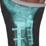 You can now order casts with your x-ray printed onto it