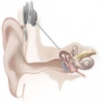 3021353-inline-cochlear-implantnational-institutes-of-health