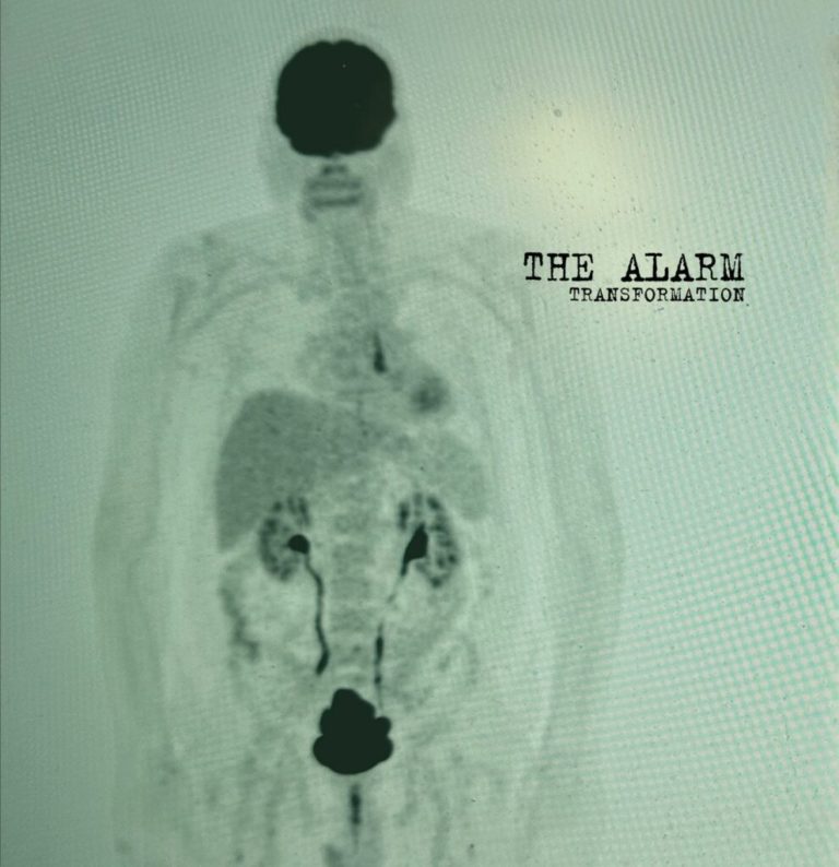 The Alarm Release “Live Today” and Announce Final Album ‘Transformation’ as a Testament to Mike Peters